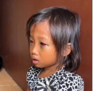 Kasus Dugaan Kekerasan di Sekolah Dasar, Siswi Alami Pecah Pembuluh Darah di Mata