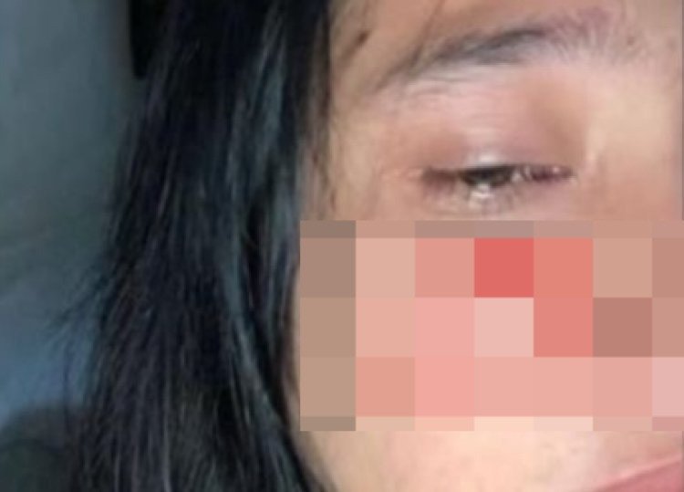 Wanita ini Ungkap Kisah Pilu Dianiaya oleh Suami Hingga Banyak Lebam